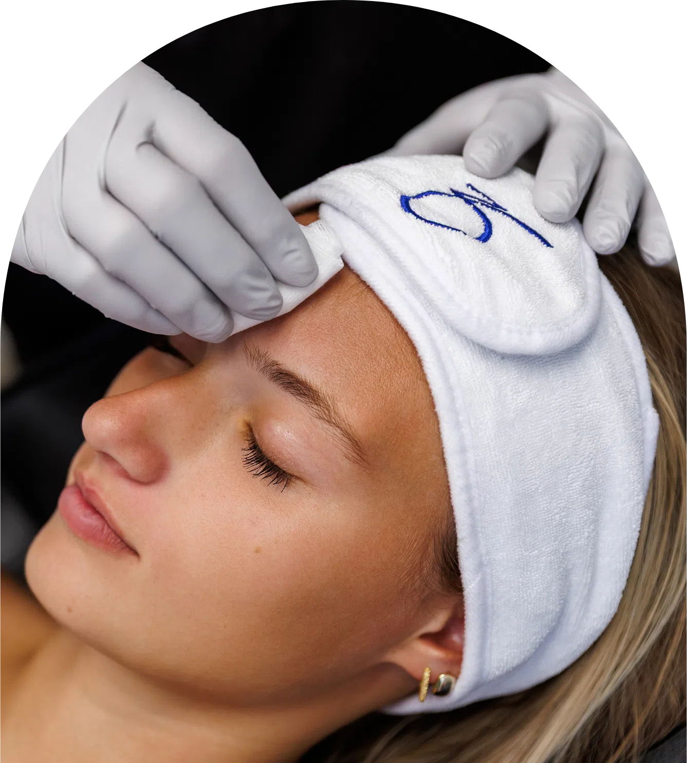 Chemical peel facial treatment