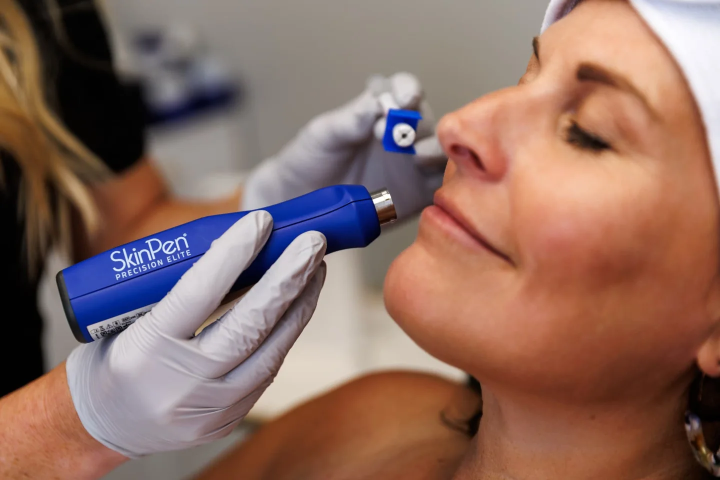Close-up of a SkinPen microneedling treatment at Lemonade Aesthetics in Manhattan, KS
