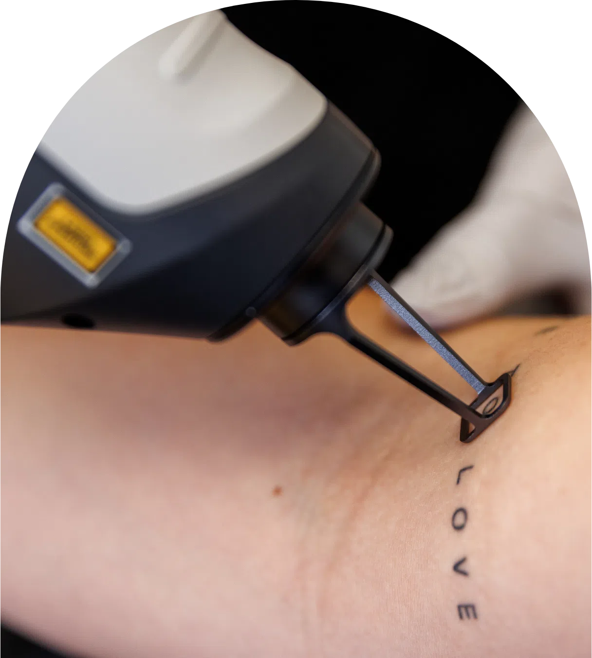 Laser tattoo removal treatment